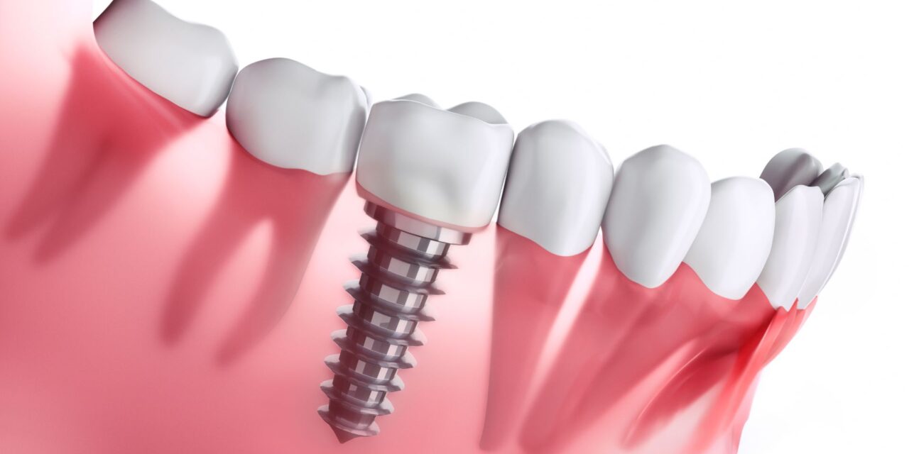 Implantes dentales: Tipos, tratamiento y cuidados